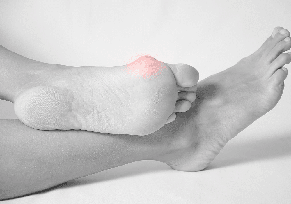 Achilles pain is usually a result of tendinitis caused by tight or fatigued calf muscles which transfer too much of the burden of walking or running to the Achilles tendon.