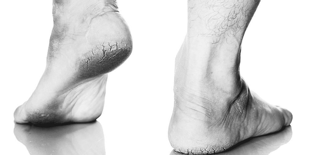 Cracked Heels? Our Podiatrists can help Foot Mechanics