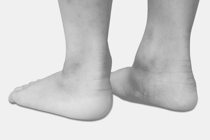 When the foot pronates, the arch lowers. Pronation is a normal foot movement and is needed for normal foot function in walking and running.