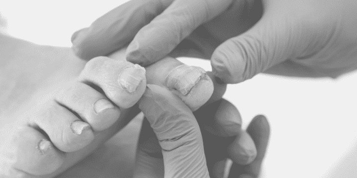Thickened Toenails - Foot Mechanics Thickened Toenails - Foot Mechanics