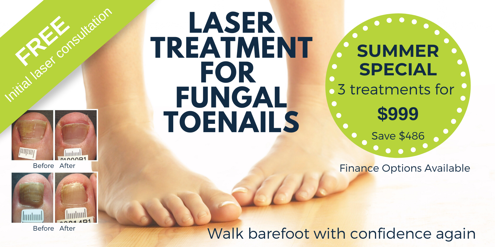 Fungal Nail Infection Treatment Laser | Foot Mechanics New Zealand