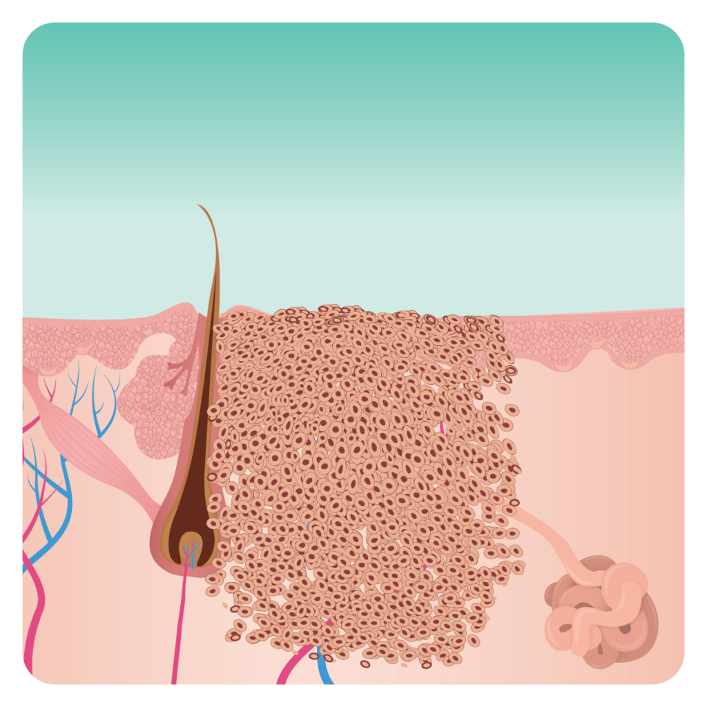 Our Podiatrists Can Diagnose And Treat Corns Warts And Verruca Foot our-podiatrists-can-diagnose-and-treat-corns-warts-and-verruca-foot